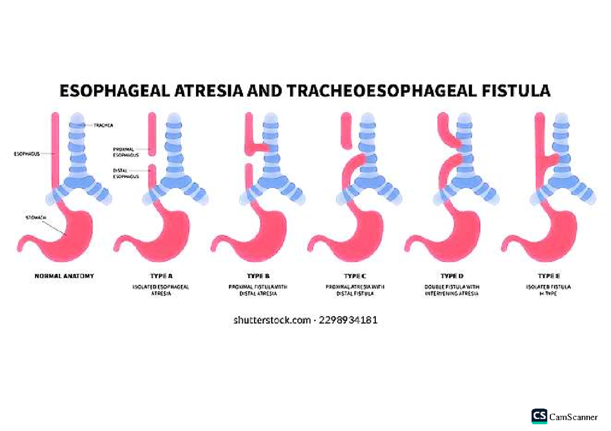 Pediatric Disorders: Esophageal Atresia & Tracheoesophageal Fistula ...