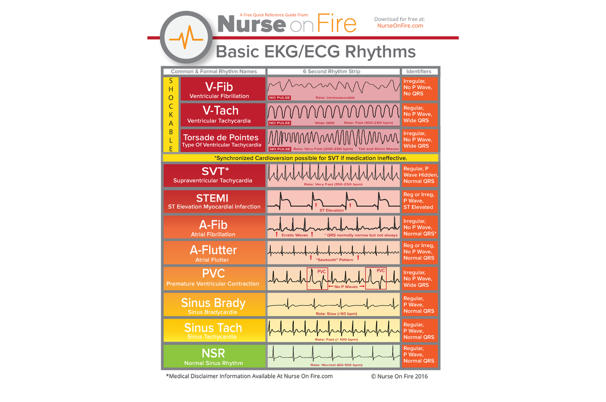 EKG - EKG - A Free Quick Reference Guide From: Nurse onFire Download for free at: NurseOnFire Basic - Studocu for Free Printable Ekg Practice Worksheets