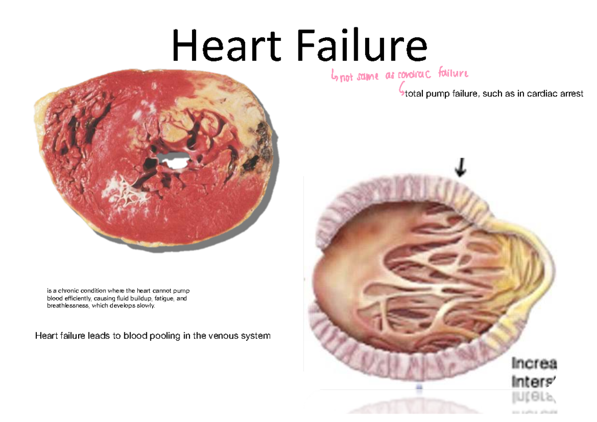 Heart Failure Overview and Mechanisms - Studocu