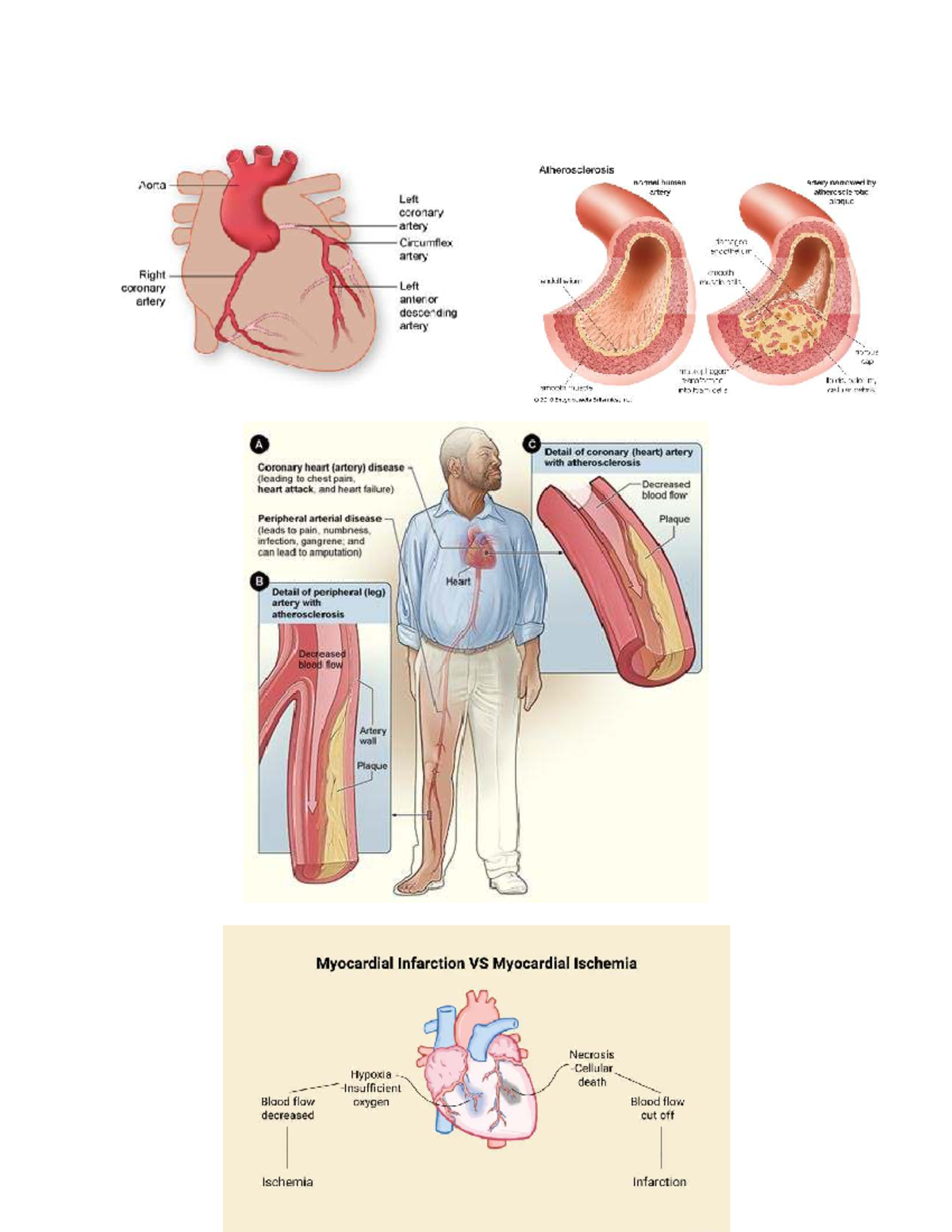 Management of Patients with Coronary Vascular Disorders Patho Overview ...