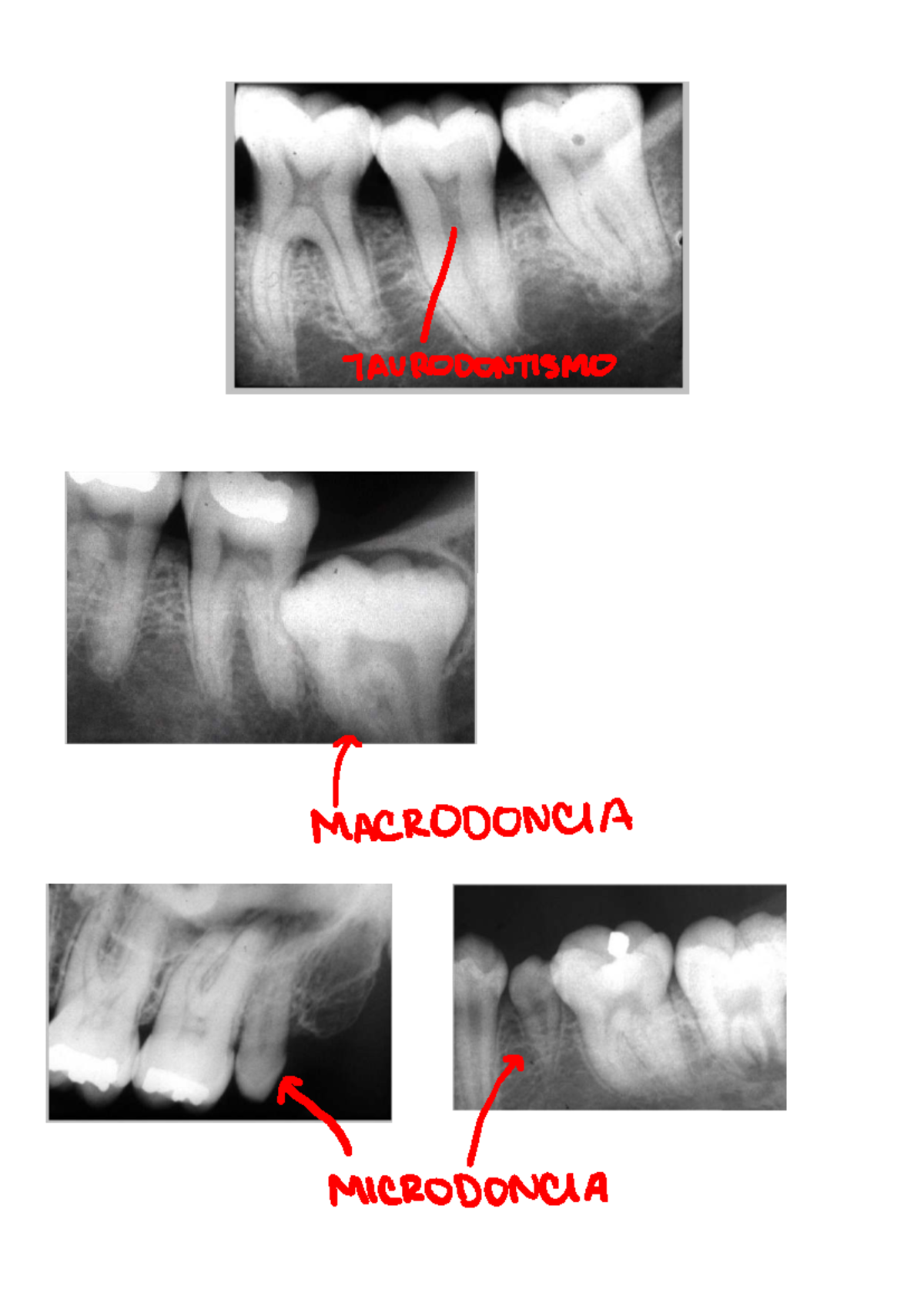 Anomalías Radiográficas en Odontología: Taurodontismo y Más (Rx 2 ...