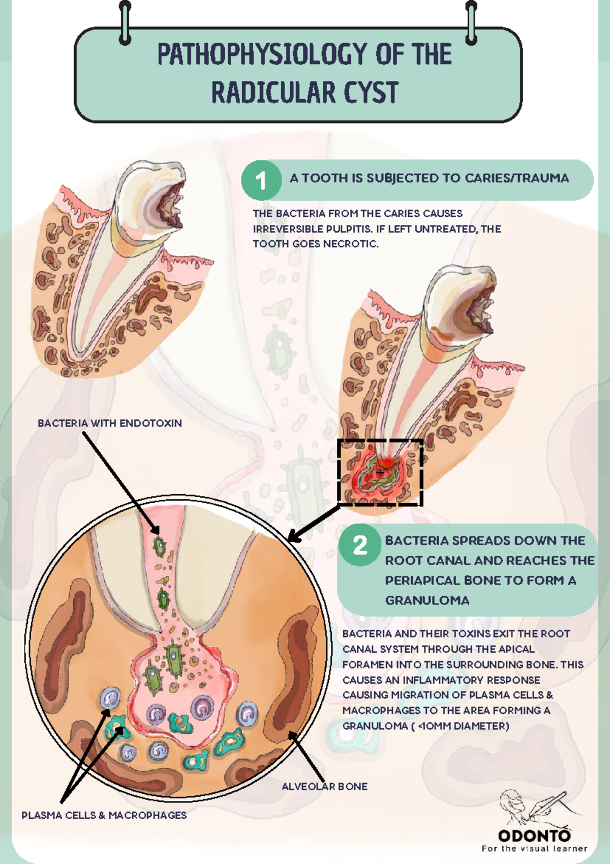 Pathophysiology of Radicular Cyst in Odonto 2: A Detailed Study - Studocu