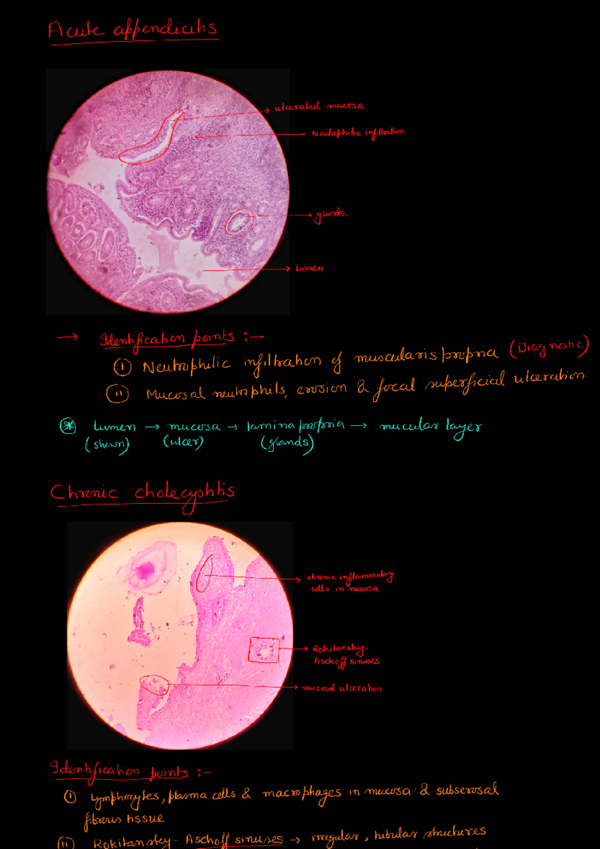 Histopathology slides (pathology) - Acute appendicitis ulcerated mucosa ...