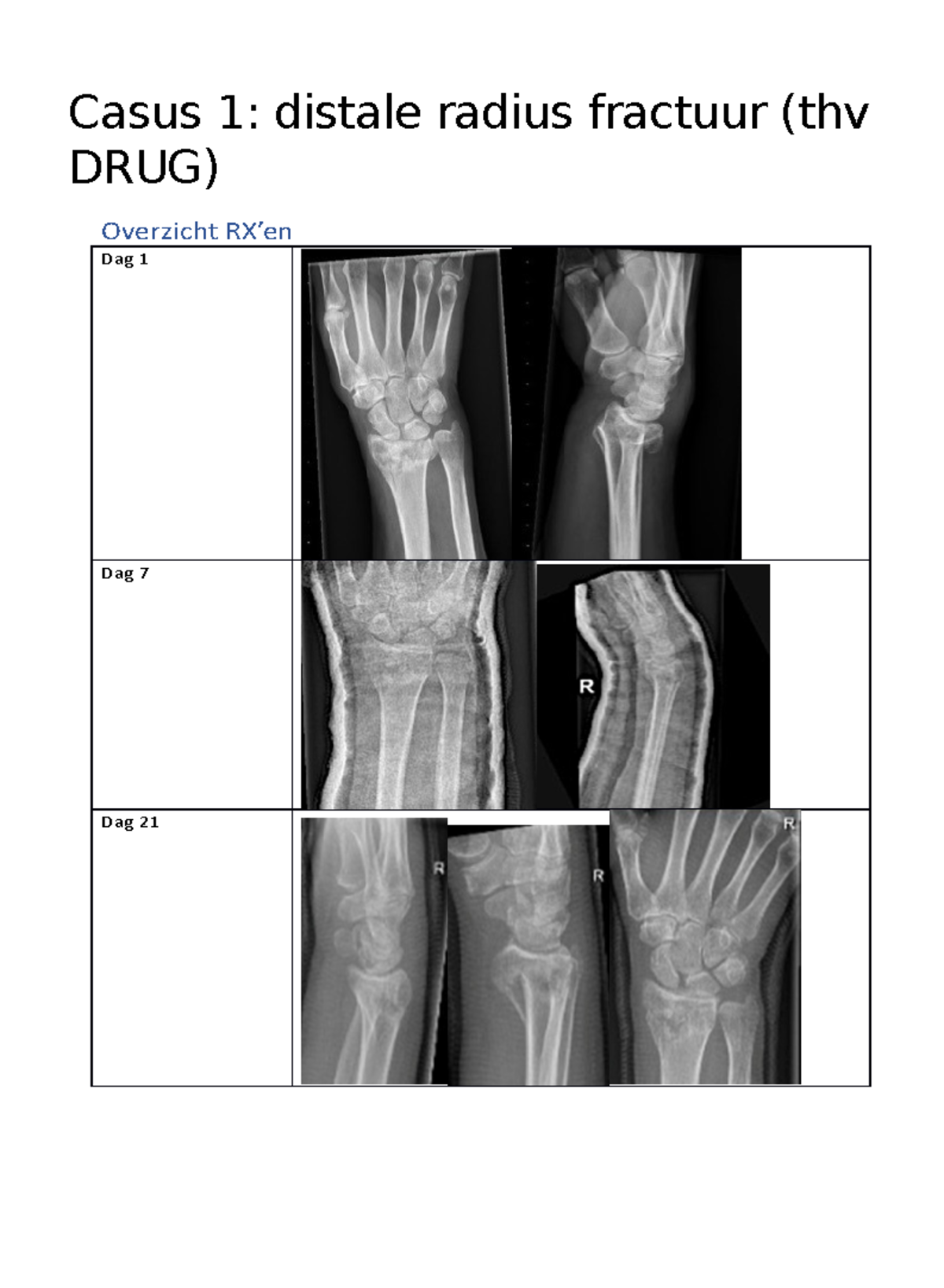 Casusstudie: Distale Radius Fractuur Behandeling en Evaluatie (DRUG ...
