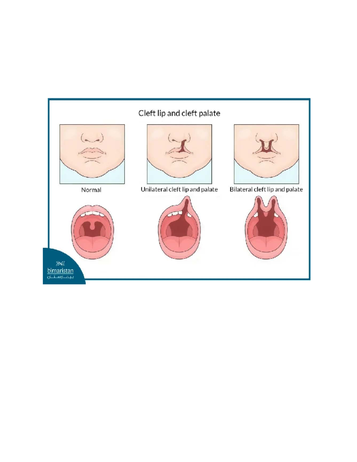 Cleft lip and palate - /// - NSG 340 - Cleft lip and cleft palate ...