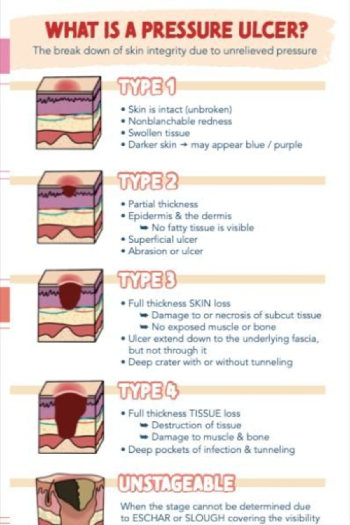 Pressure Injury: Understanding Types and Staging of Pressure Ulcers ...