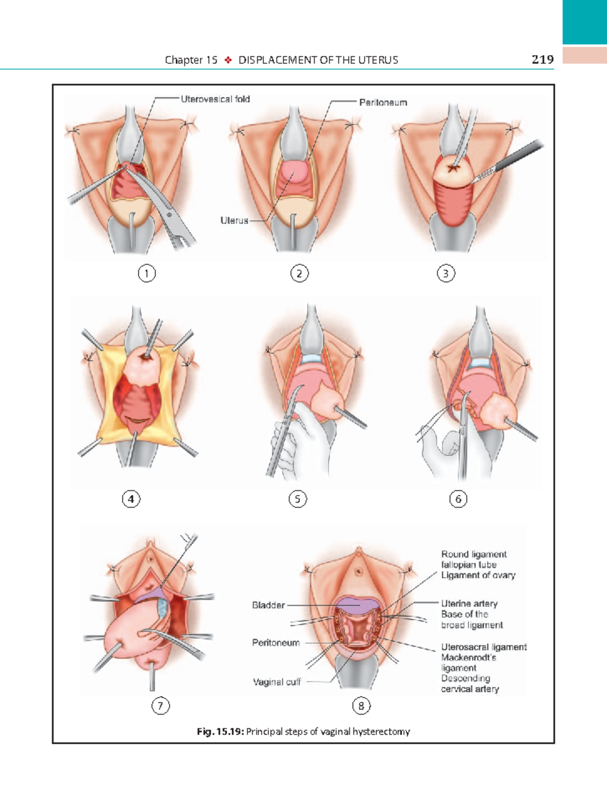 Dc Dutta's Textbook of Gynecology - Chapter 15: Uterine Displacement ...