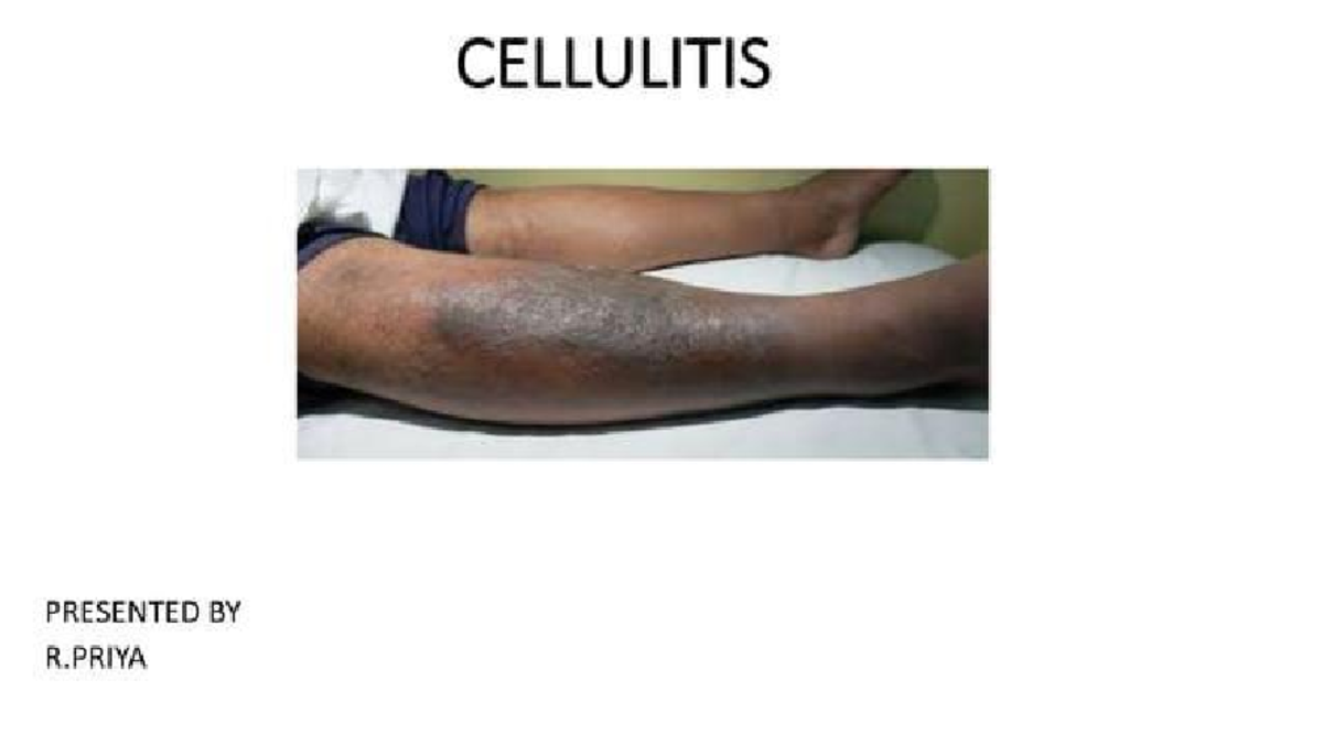 CELLULITIS: A Comprehensive Overview for R.PRIYA's Study - Studocu