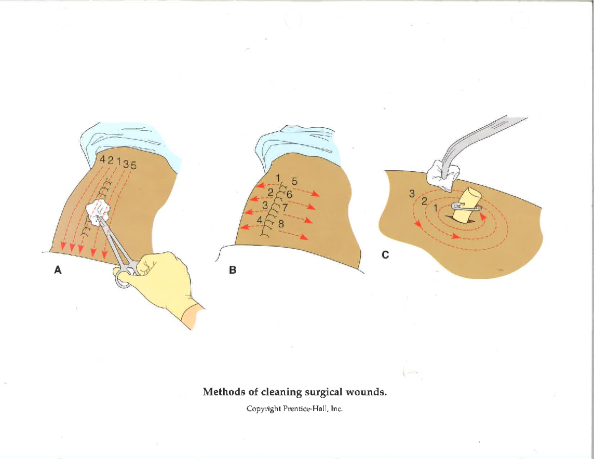 Methods of cleaning surgical wounds - NURSING 102 - Copyright Inc ...