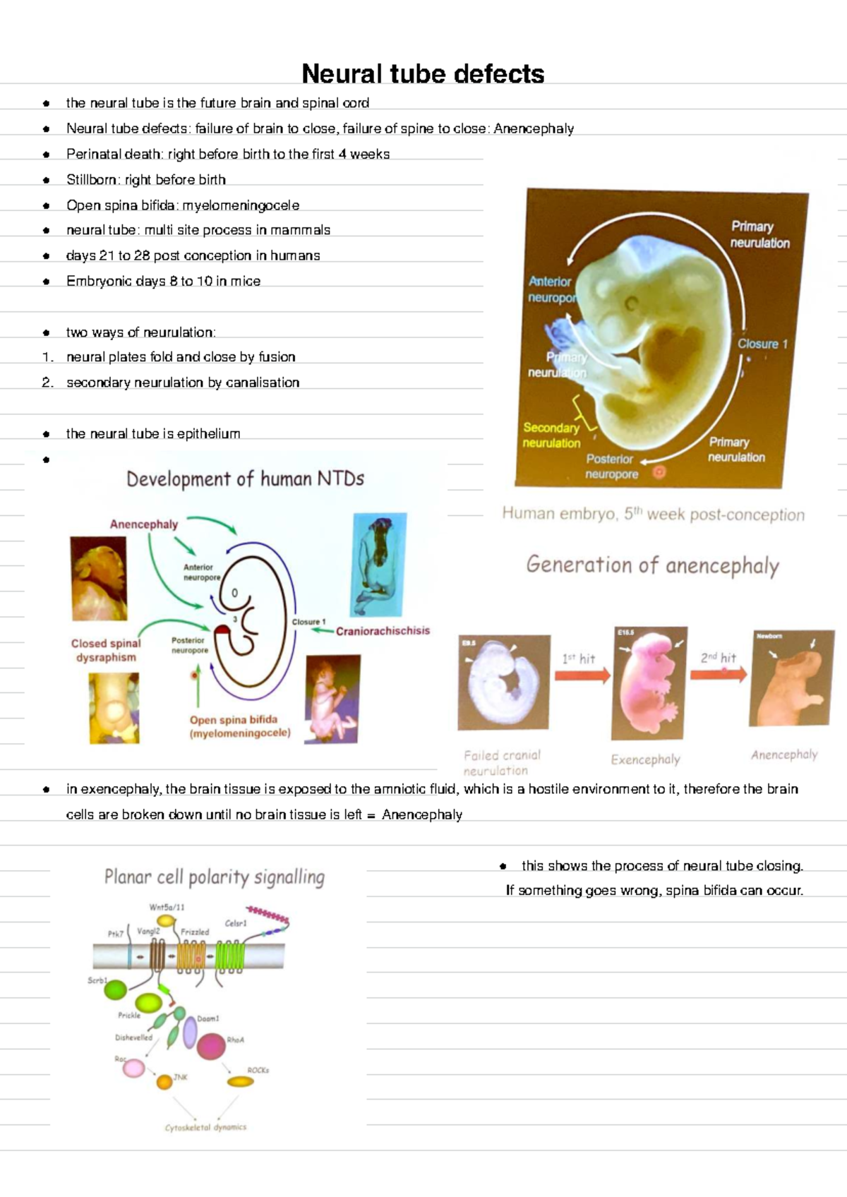 Anatomy notes - Neural tube defects - Neural tube defects the neural ...