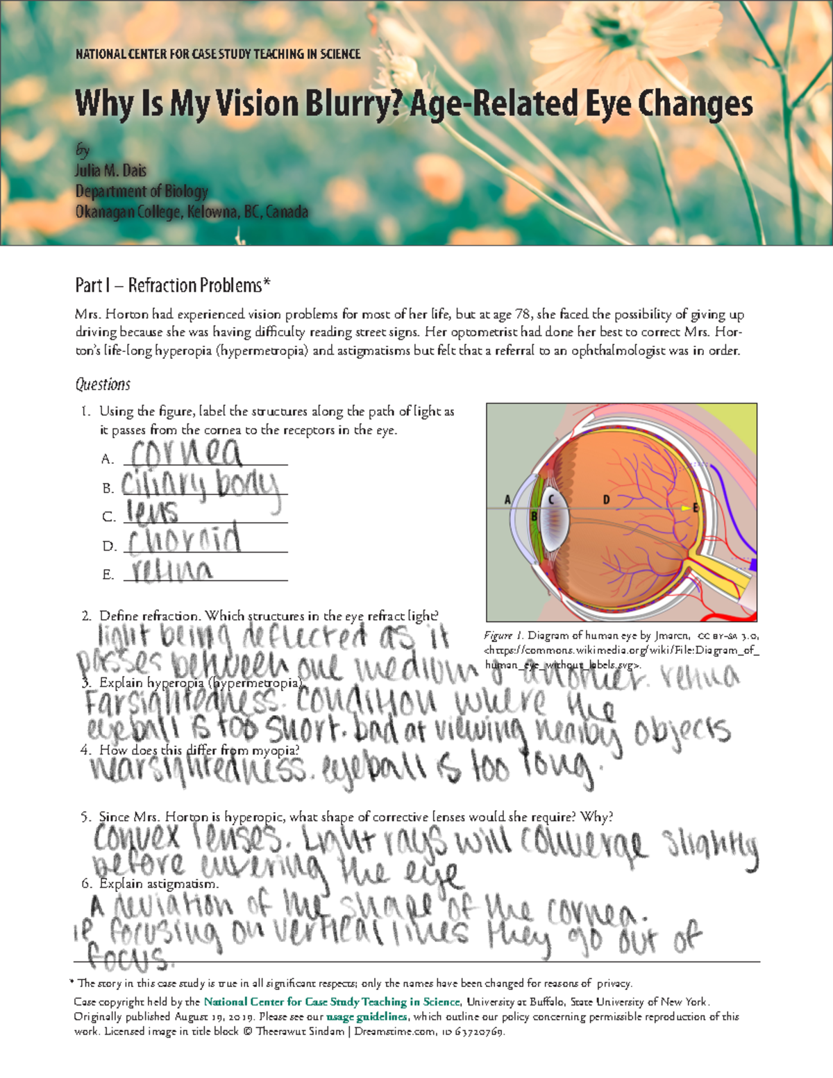Vision+CS+Part+A - Understanding Age-Related Eye Changes Case Study ...