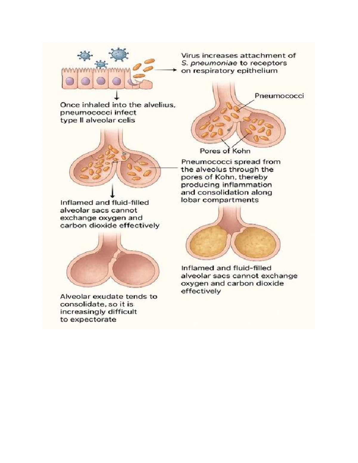 Respiratory Pathophysiology: Impact of Viral Infections on Pneumococci ...