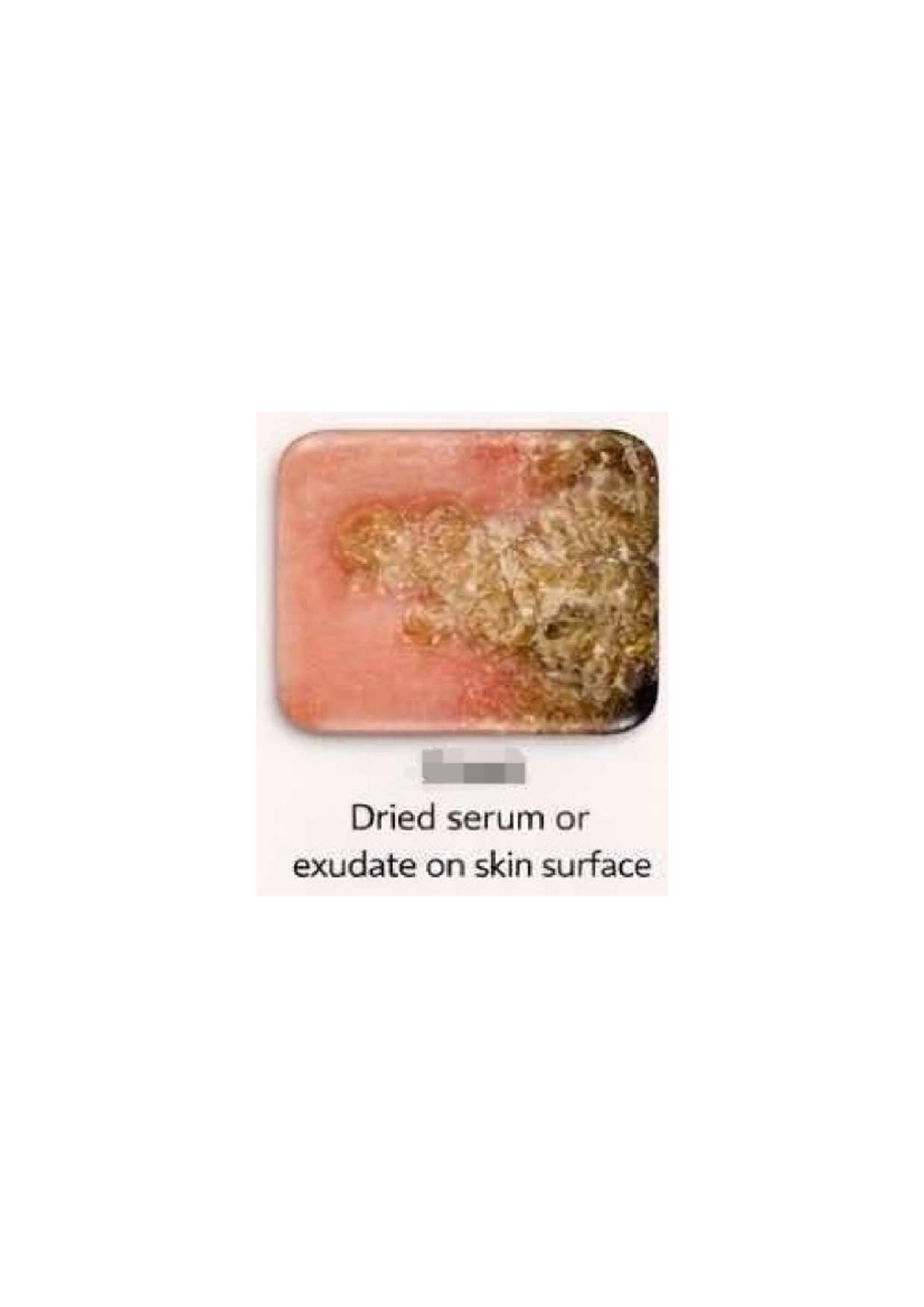 SKIN Infections: Understanding Lesions and Fluid Collections - Studocu