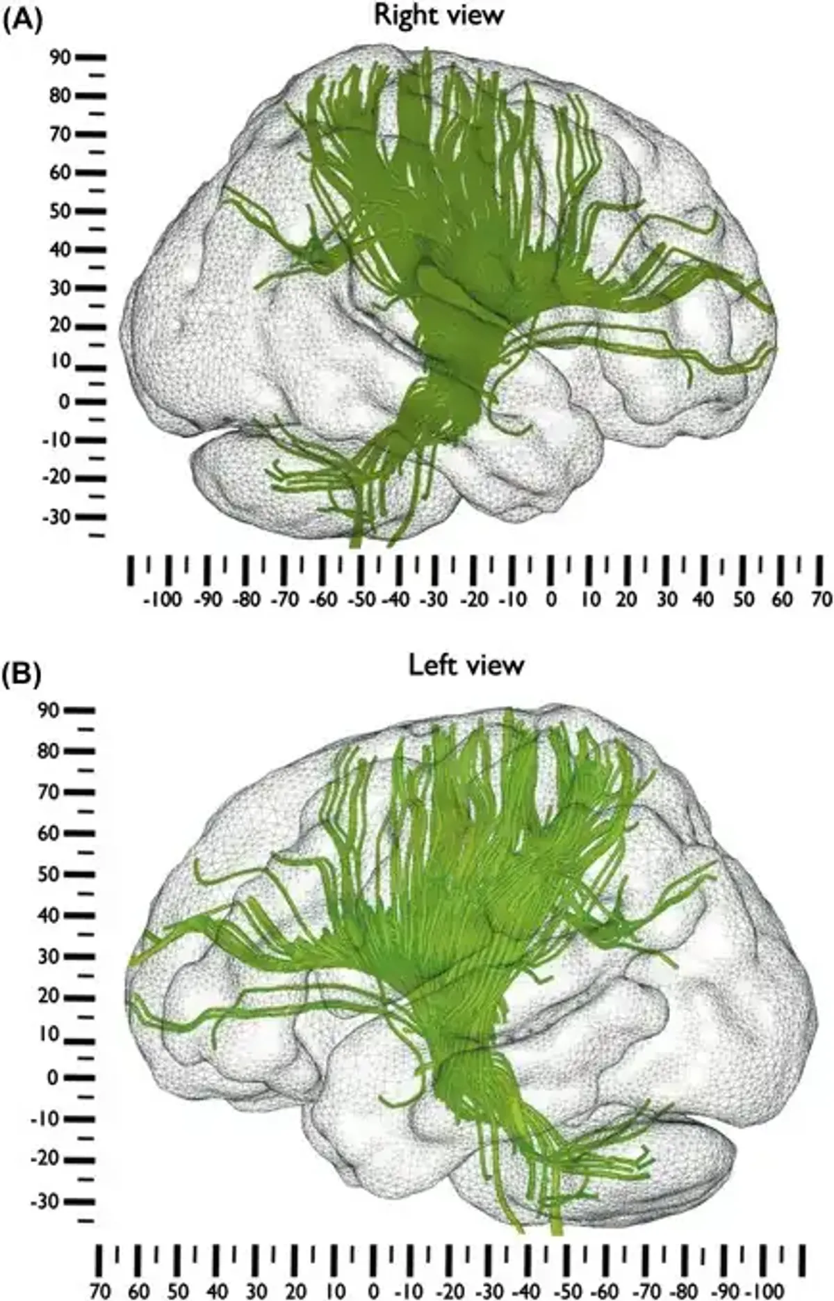 CVA Case Study - Analyzing Left Anterior Corona Radiata Infarct - Studocu