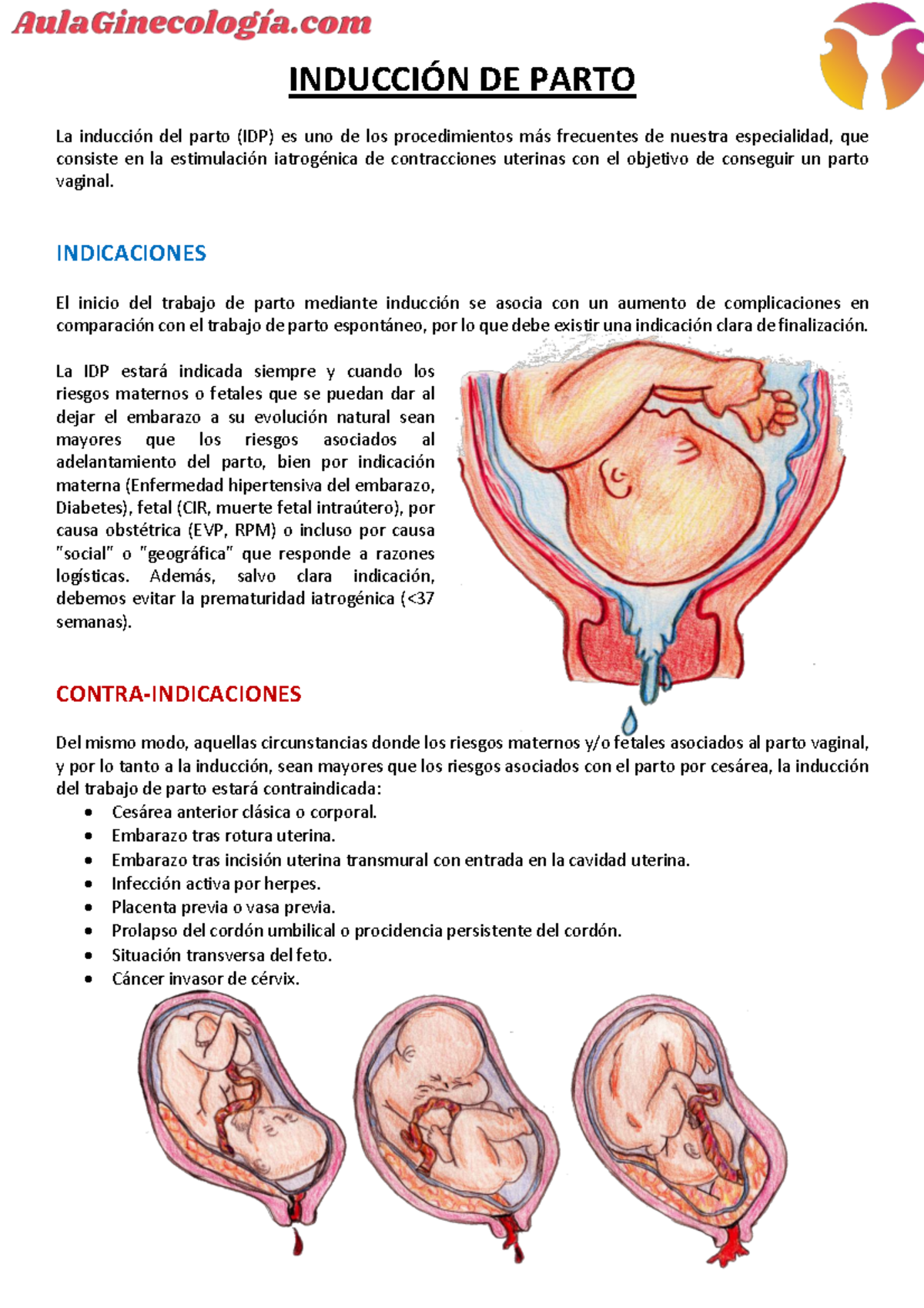 INDUCCIÓN DE PARTO - Apuntes y Consideraciones Clínicas - Studocu