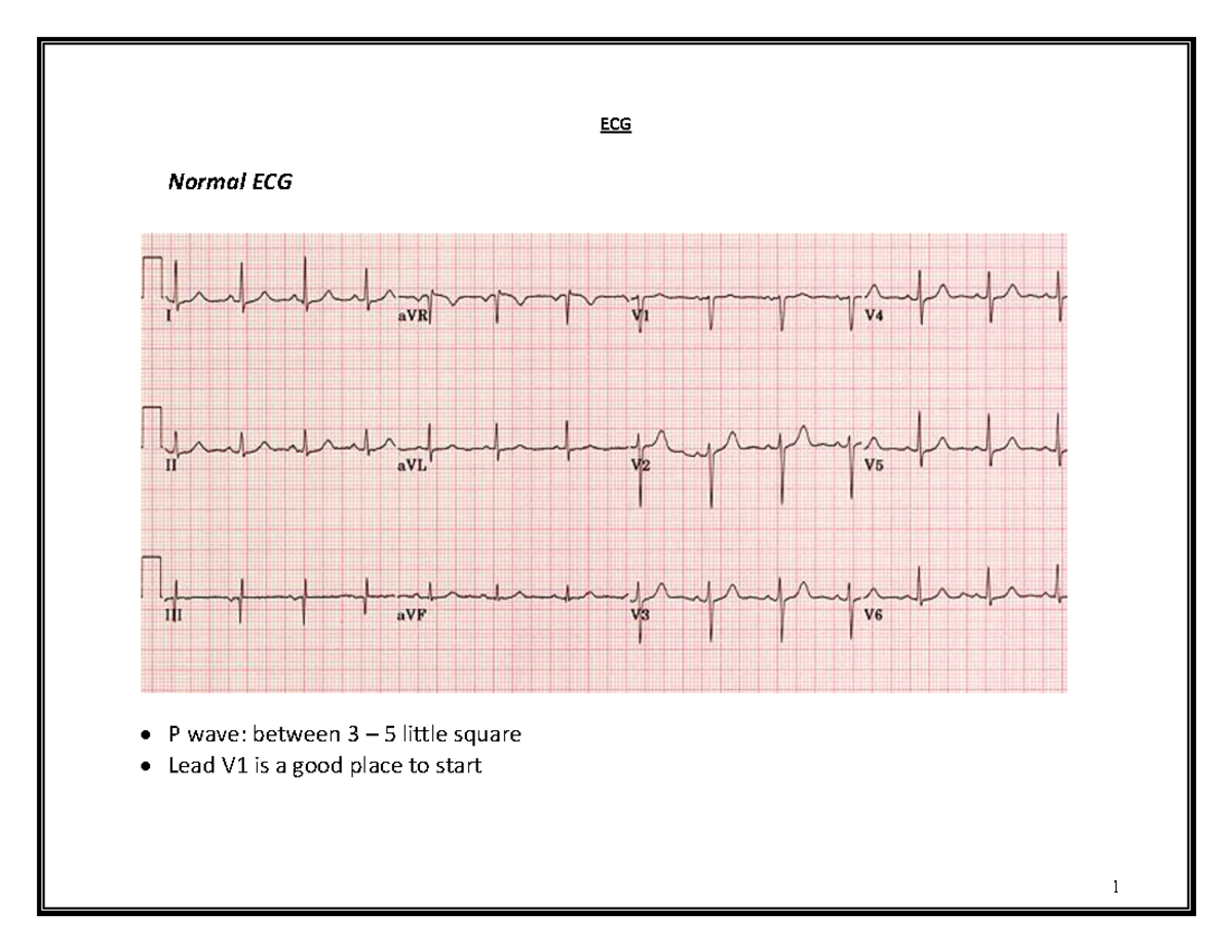 ECG Analysis: Normal Sinus Rhythm & Arrhythmias Overview - Studocu