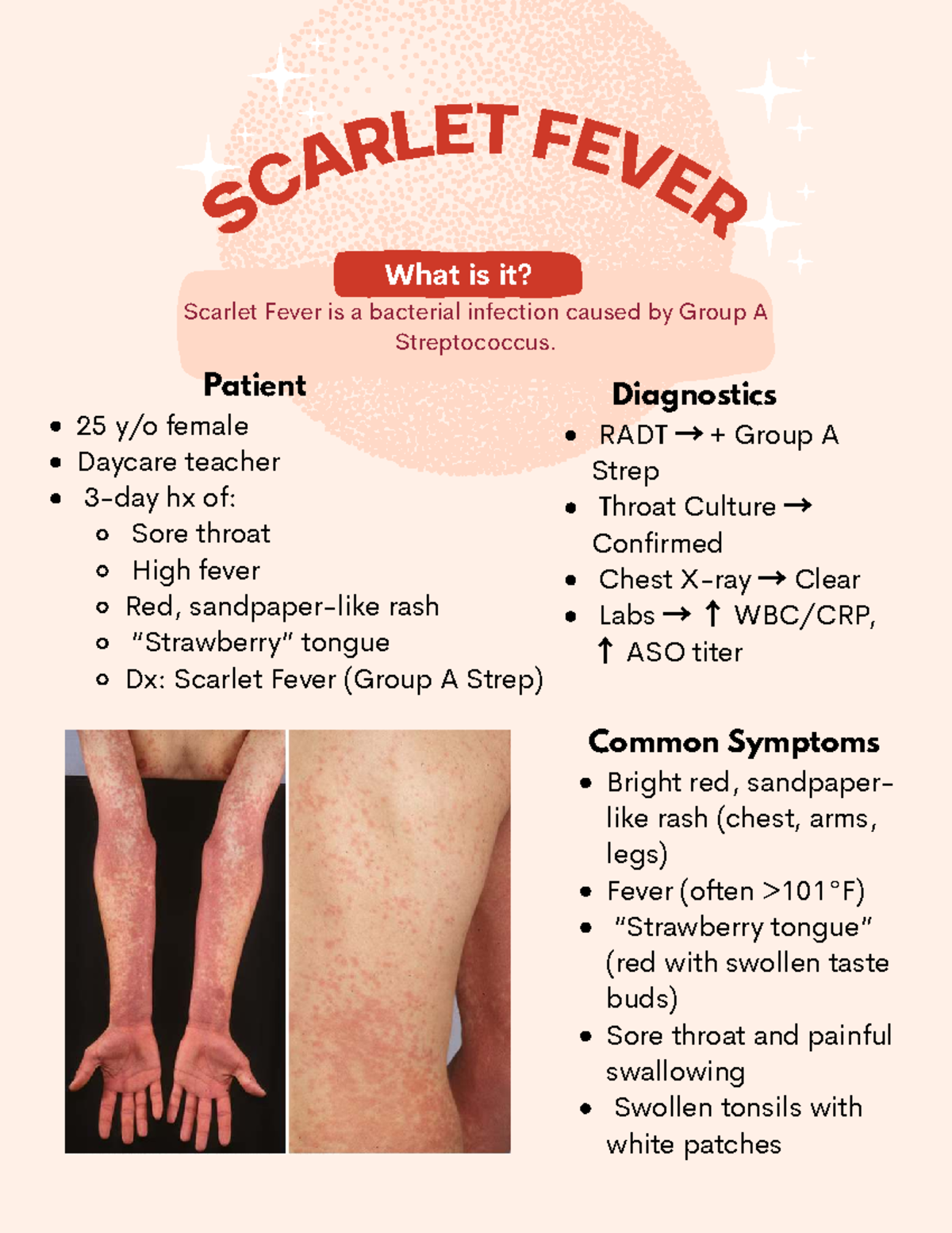 Scarlet Fever - S C A R L E T FE V E R Scarlet Fever is a bacterial ...