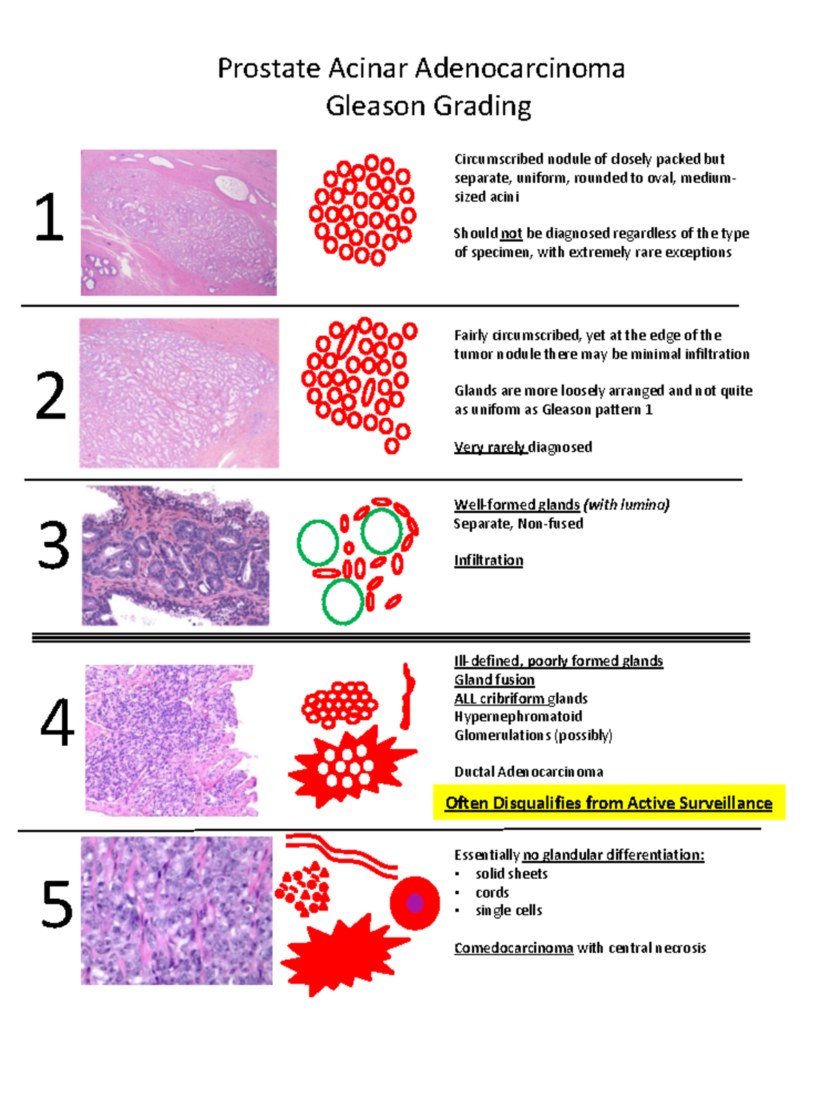Prostate Grading - Prostate Acinar Adenocarcinoma Gleason Grading ...