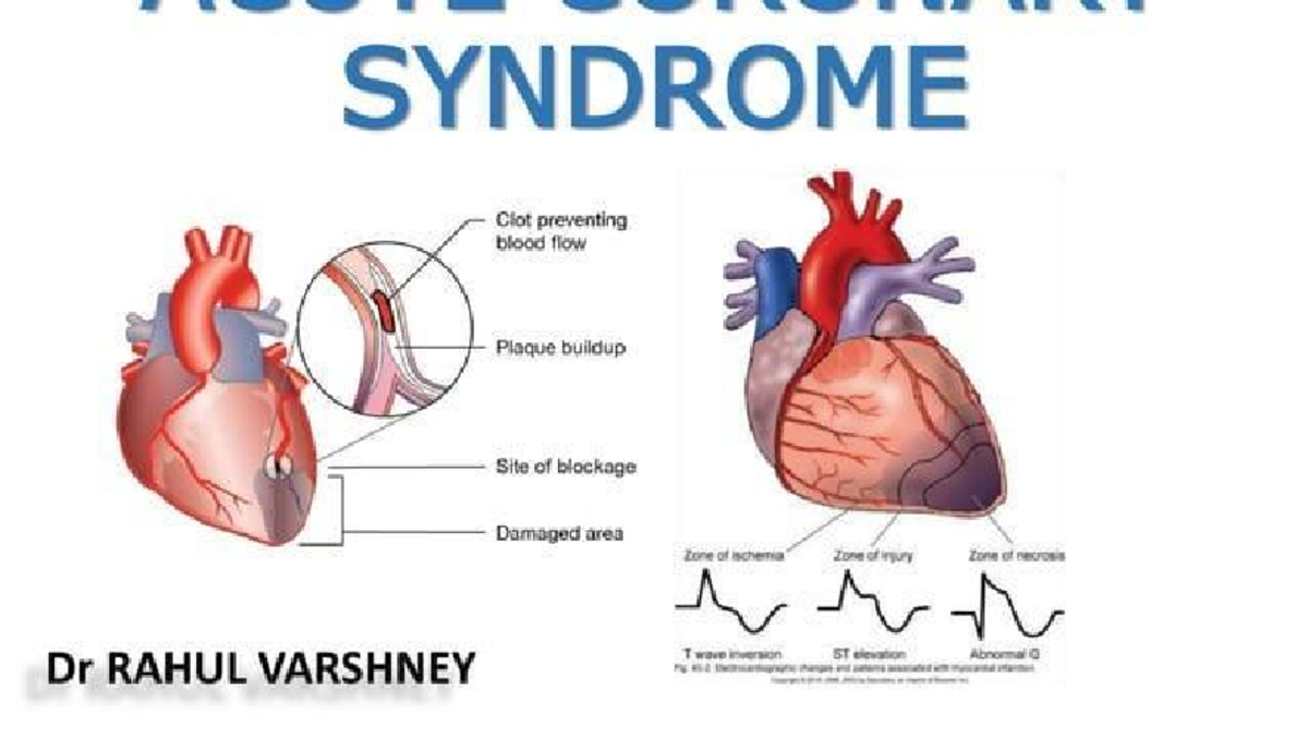 ACS Overview: Understanding Acute Coronary Syndrome and Its Symptoms ...