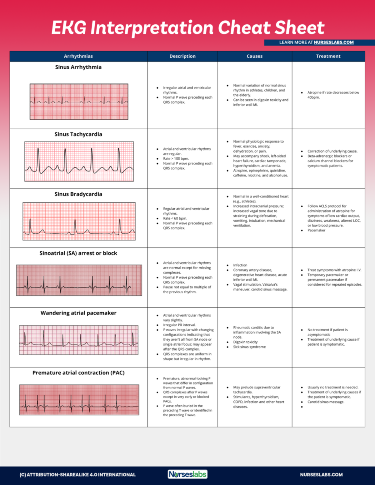 EKG Interpretation Cheat Sheet for Heart Arrhythmias - Nurseslabs